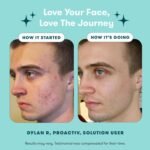 Proactiv 3 Step Acne Treatment System, 60 Day Complete Skincare Kit with Benzoyl Peroxide Cleanser, Toner, Repairing Treatment, and 15‑Count Pimple Patch - Image 6