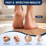 Urea Cream 40 Percent with 2 Percent Salicylic Acid, Foot & Hand Cream for Dry Cracked Heels, Callus Softener for Feet, Exfoliating Foot Cream for Rough Thick Skin, 5.29 oz - Image 4