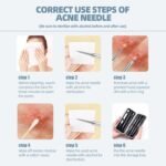Blackhead Remover Comedone Extractor Acne Removal Kit.. - Image 5