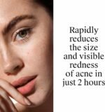 Neutrogena Rapid Clear Stubborn Acne Spot Treatment Gel, Maximum Strength 10% Benzoyl Peroxide Treatment Medication for Acne Prone Skin, Pimple Cream Reduces Size & Redness, 1 oz - Image 7