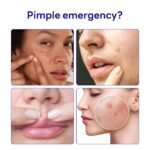 MEDIHEAL Derma Clear Acne Pimple Spot Patches, Tea Tree (132 Count) | Pre-Extraction Acne Pimple Patch | Hydrocolloid Patches with Tea Tree & Salicylic Acid | Acne Relief | Korean Pimple Patches - Image 3