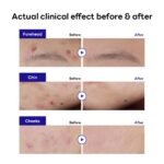 MEDIHEAL Derma Clear Acne Pimple Spot Patches, Tea Tree (132 Count) | Pre-Extraction Acne Pimple Patch | Hydrocolloid Patches with Tea Tree & Salicylic Acid | Acne Relief | Korean Pimple Patches - Image 4