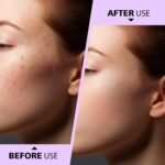 Teenitor Pimple Extractor Acne Treatment Tool Surgical Grade Blackhead Comedone Removal 2-in-1 Popper Tool for Face Nose Blackhead Extractor Tool Silver - Image 7