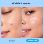 7 Sizes 831 Counts Pimple Patches Variety Pack for Face, Back | Hydrocolloid, Large Blemish Patches for Body, Chin, Chest, Cheek, Shoulder, Neck, Forehead (Dot, Moon, Rectangular, Square) - Image 6