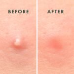 Rael Miracle Invisible Spot Cover Hydrocolloid Acne Pimple Patches (96 Ct) | Ultra-Thin Patch for Face, Absorbs Fluid From Blemishes, Facial Sticker, Korean Skin Care, Pore Care, 2 Sizes - Image 6
