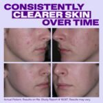 Differin Epiduo Acne Gel Treatment, Adapalene & Benzoyl Peroxide, 45g Pump | FDA-Approved OTC Acne Gel, Adapalene 0.1% + Benzoyl Peroxide 2.5%, Clears & Prevents Breakouts, Strongest OTC, 90 Day Supply - Image 6