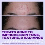 Differin Epiduo Acne Gel Treatment, Adapalene & Benzoyl Peroxide, 45g Pump | FDA-Approved OTC Acne Gel, Adapalene 0.1% + Benzoyl Peroxide 2.5%, Clears & Prevents Breakouts, Strongest OTC, 90 Day Supply - Image 9