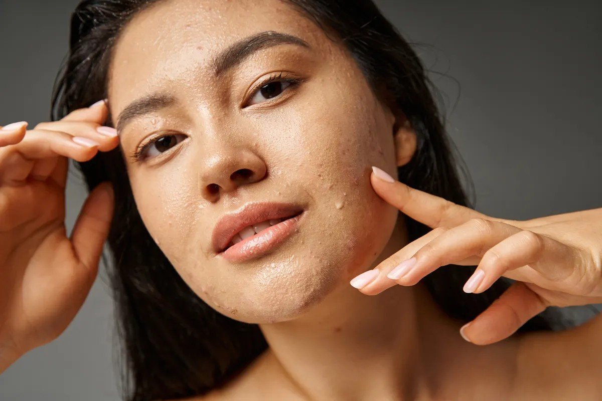 Eucerin taps live probiotics for microbiome-friendly acne care